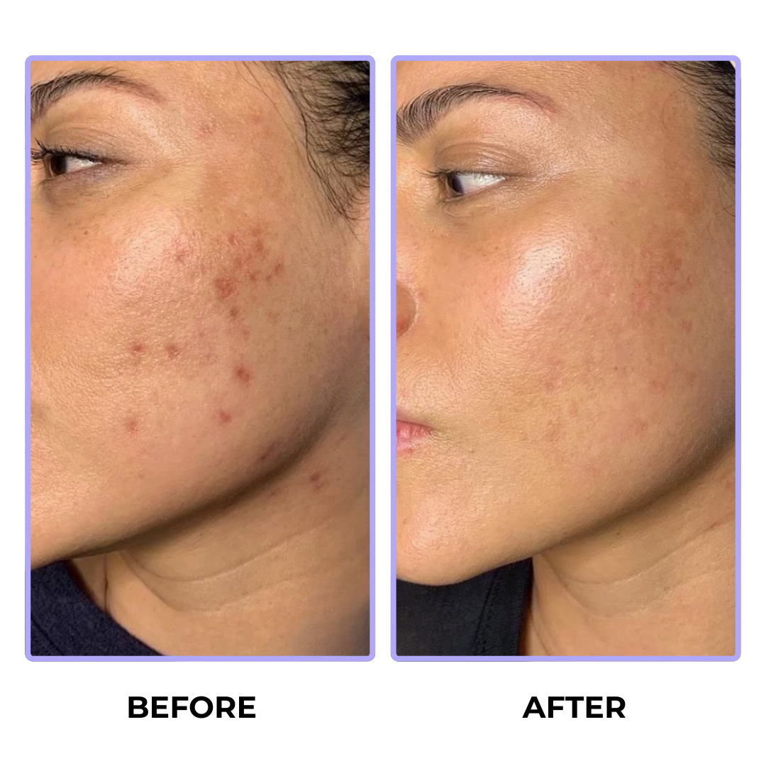 Cosmetific™ DermaWave HF Pro