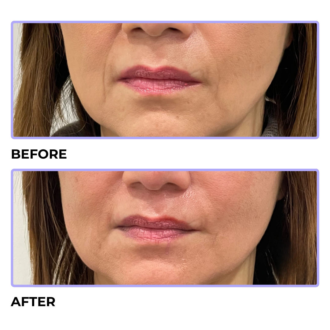 Cosmetific™ DermaWave HF Pro